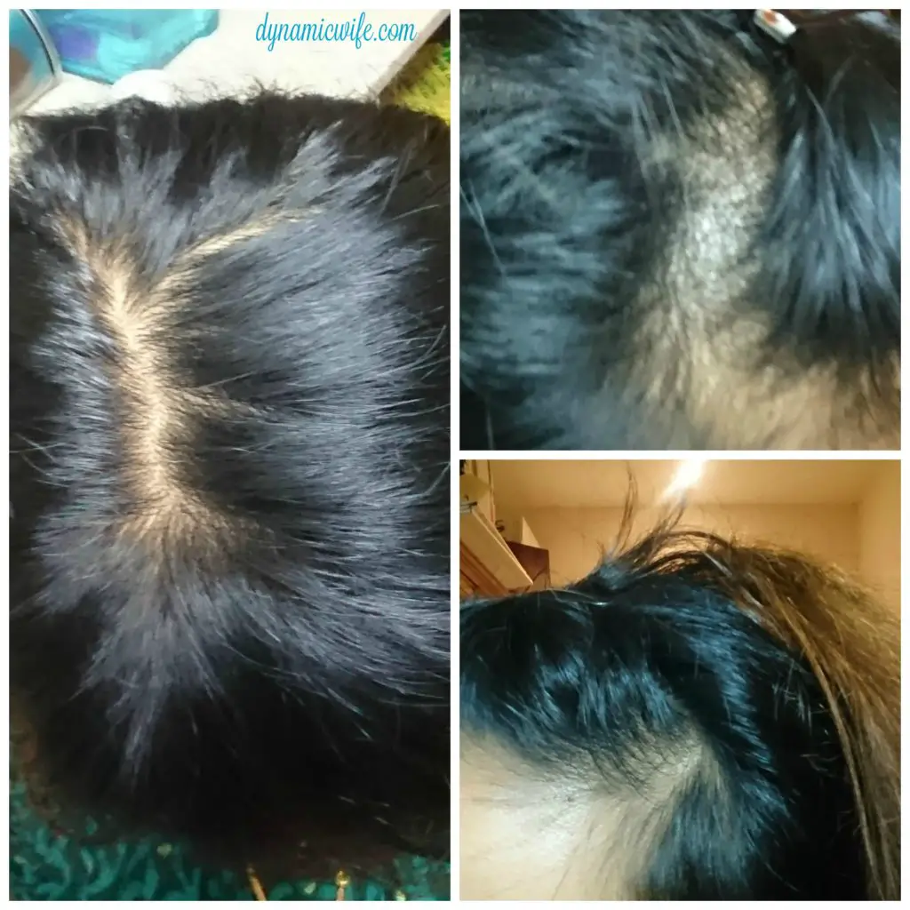 baldspot-before-after