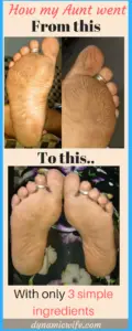 Amazing Listerine Foot Bath Soak for Dry Cracked Feet (Before/After)