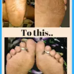 Amazing Listerine Foot Bath Soak for Dry Cracked Feet (Before/After)