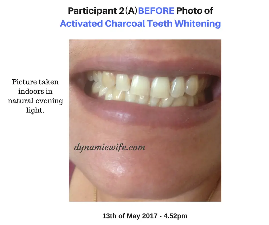 Participant 2 Before Photo of Activated Charcoal Whitening Results