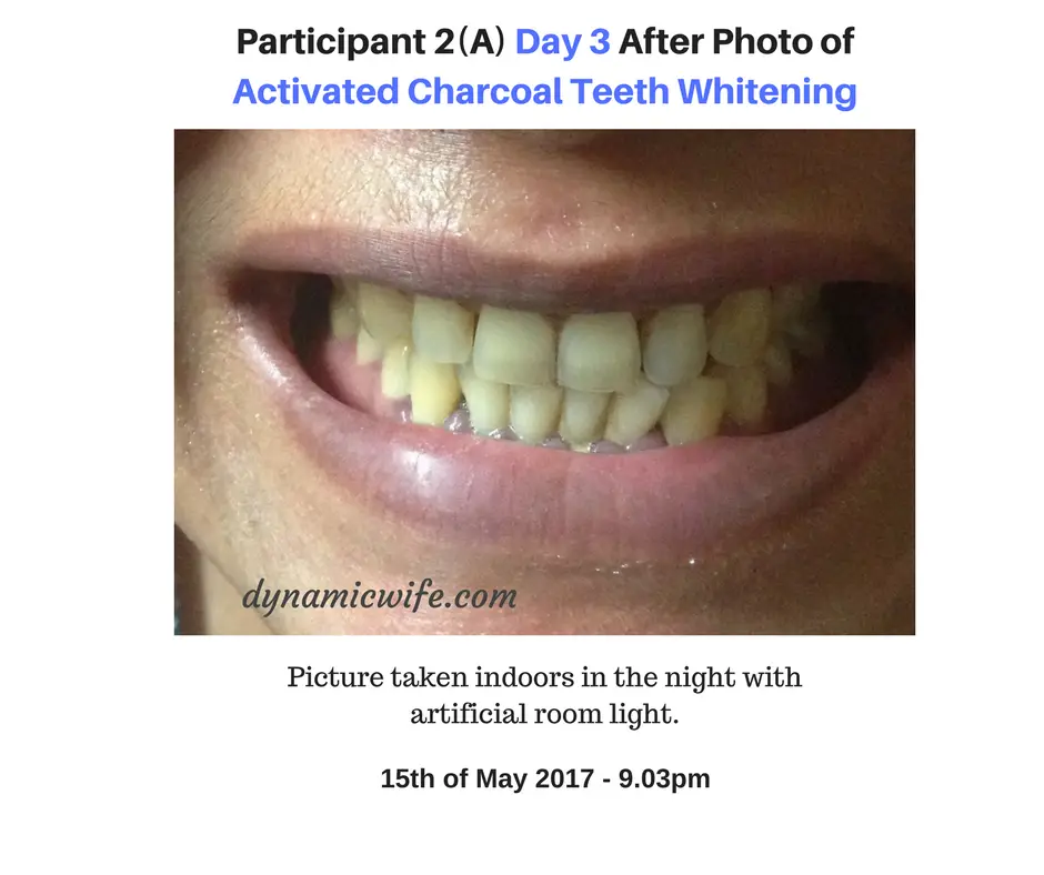 Participant 2 Day 3 Photo of Activated Charcoal Whitening Results