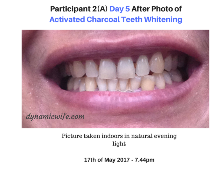 Activated Charcoal Teeth Whitening Experiment 2 REAL Before/After Pics