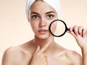 Best Moisturizers for Acne Prone Skin