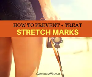 how to prevent stretch marks